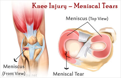 knee-injury-meniscus